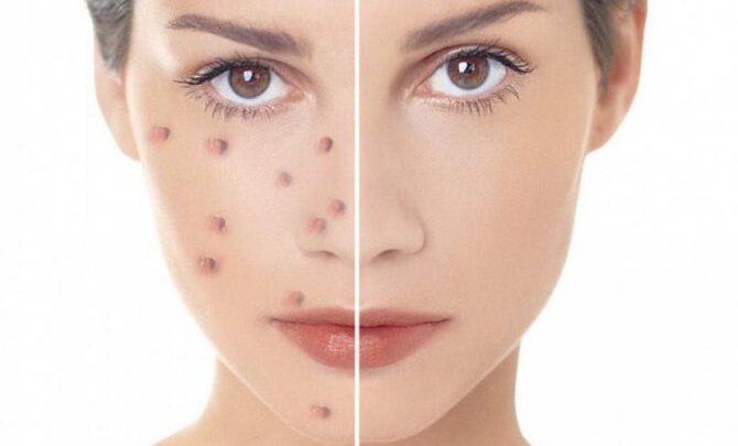 Чистка особи від прищів і чорних крапок в домашніх умовах