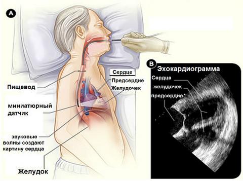 Порушення серцевого ритму: види, причини, ознаки та виявлення, лікування