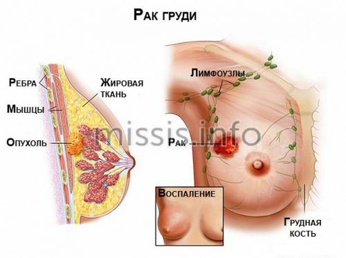 Що відбувається з організмом при появі пухлини