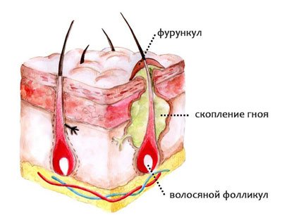 Що таке абсцес - гнійник або нарив