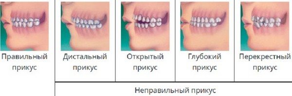 Що таке вініри, як їх ставлять на зуби, плюси і мінуси, показання.  вартість