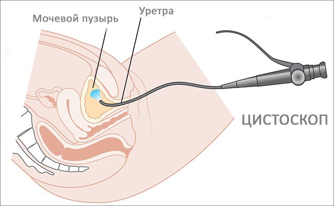 цистоскоп