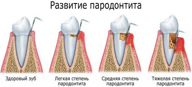 Десна опускаються.  Що робити, якщо оголюються зуби, з'явилися жовті плями, що це таке, як їх відновити, лікування, причини