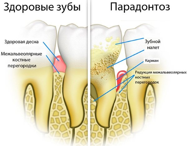 Десна опускаються.  Що робити, якщо оголюються зуби, з'явилися жовті плями, що це таке, як їх відновити, лікування, причини