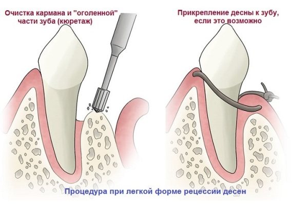 Десна відійшла від зуба при вагітності