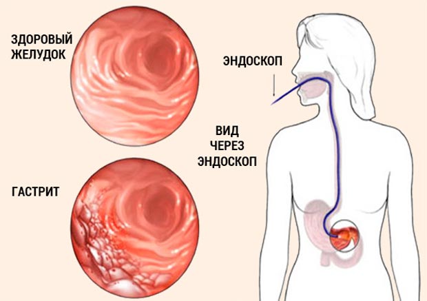 діагностика гастриту