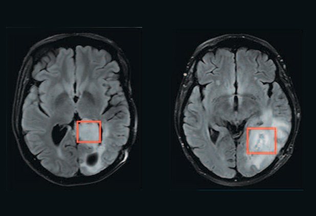 Объемное образование мозга код. Злокачественная глиобластома головного мозга снимок. Доброкачественная опухоль головного мозга мрт. Злокачественная опухоль головного мозга на мрт.