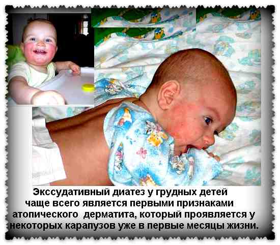 Діатез у новонароджених дітей: 4 групи, симптоми і ознаки, лікування і профілактика