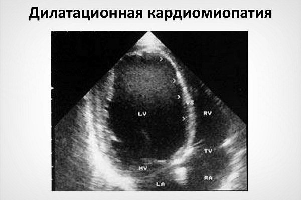 дилатаційна кардіоміопатія