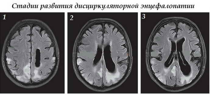 Дисциркуляторна енцефалопатія 2 ступеня