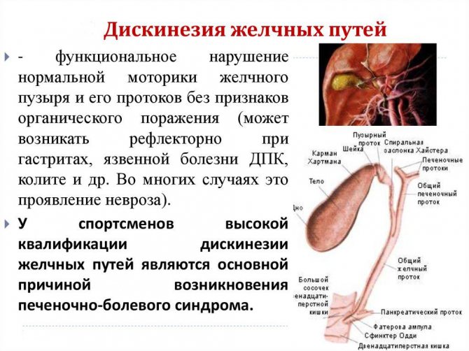 Дискінезія жовчовивідних шляхів