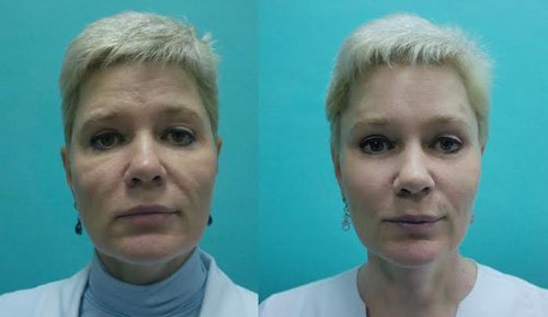 До і після Cheek Lift.