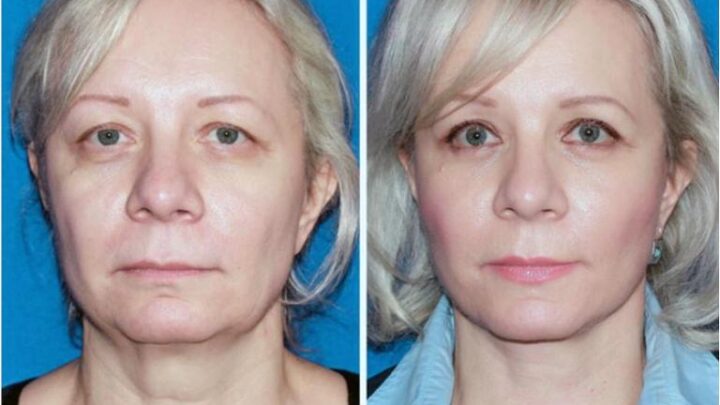 Мезоніті для підтяжки обличчя: ефективне омолодження (100% результат)