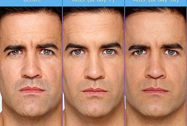 Рефайнекс в косметології. Ефективність, побічні ефекти застосування, відгуки косметологів