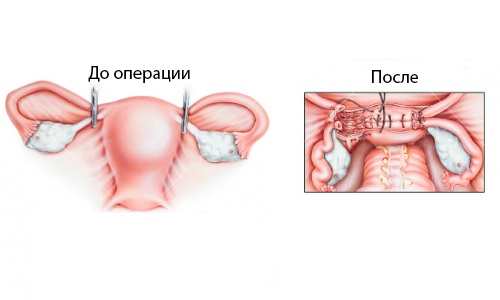 До операції видалення матки і після