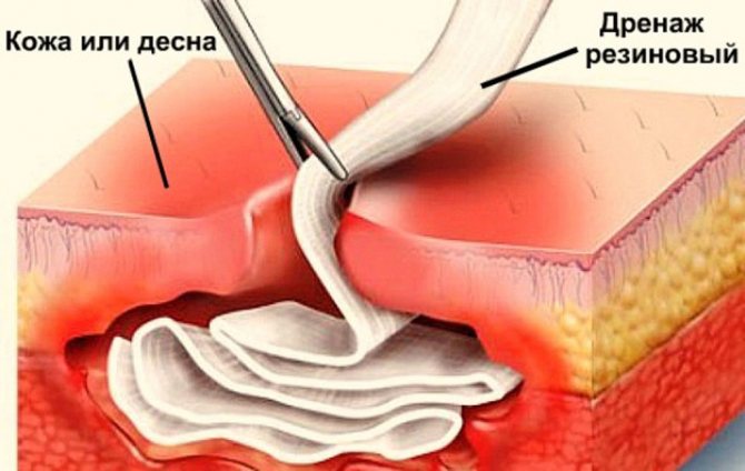 Дренаж досить часто використовується в стоматології