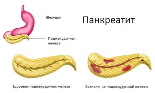 Дротаверин призначається при хронічному панкреатиті і в разі загострення запального процесу в підшлунковій залозі