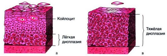 ДШМ стадії