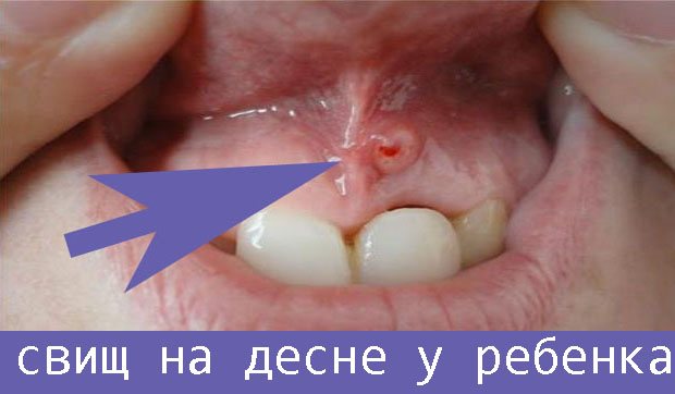 Дірка в яснах