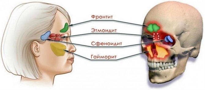 Рідина в гайморової пазухи як лікувати. Лікування і етіологія захворювань гайморових пазух