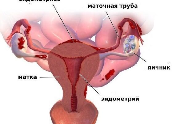 Ендометрит – симптоми і лікування ефективними препаратами та народними засобами