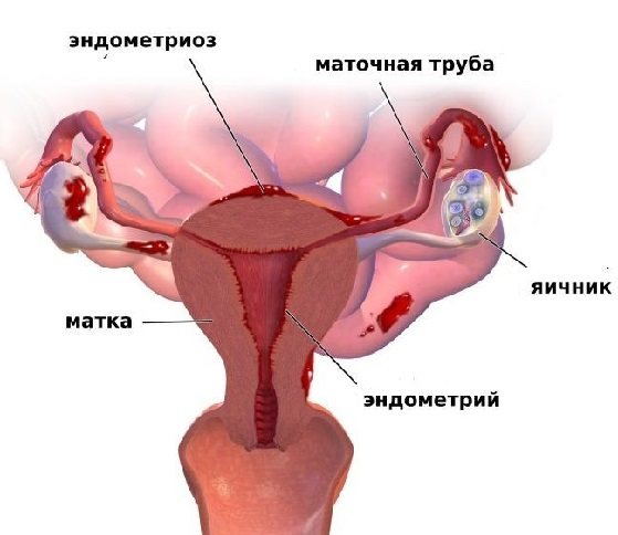 Ендометрит – симптоми і лікування ефективними препаратами та народними засобами