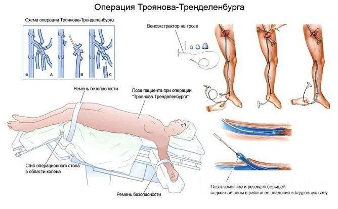 Якщо тромб знаходиться в гирлі великої підшкірної вени, виконують операцію по Троянова - Тренделенбурга