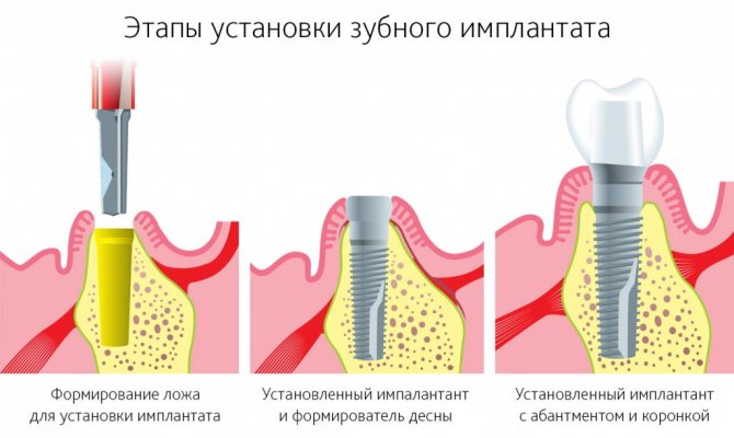 етапи протезування