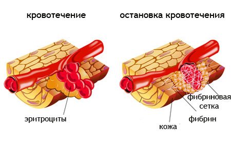 Фібриноген вище норми