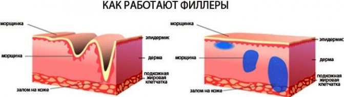 Філлери в носогубні складки, під очі, в губи, в вилиці.  Корекція носа, Носослізний борозни.  Контурна пластика обличчя