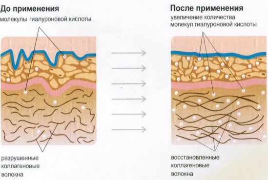 Філлери в носогубні складки, під очі, в губи, в вилиці.  Корекція носа, Носослізний борозни.  Контурна пластика обличчя