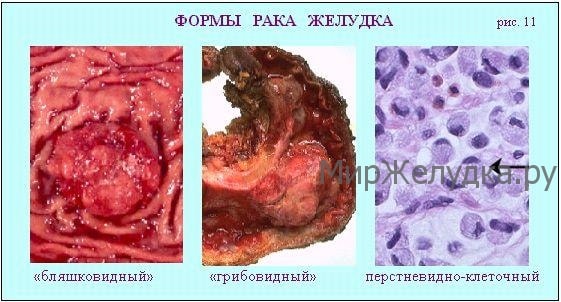 Форми раку шлунка