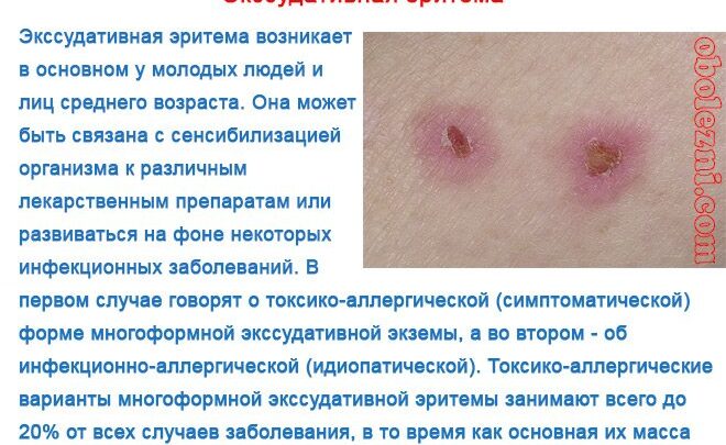 Багатоформова (поліморфна) еритема і її лікування