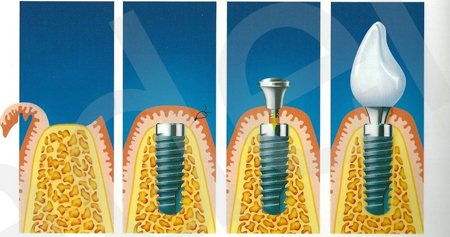 Фото: схема проведення дентальної імплантації