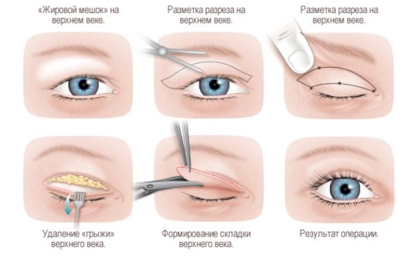 Відновлення після блефаропластики: що чекає пацієнта в реабілітаційному періоді