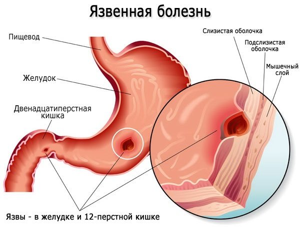 Фталазол.  Інструкція із застосування.  Дозування і як приймати таблетки