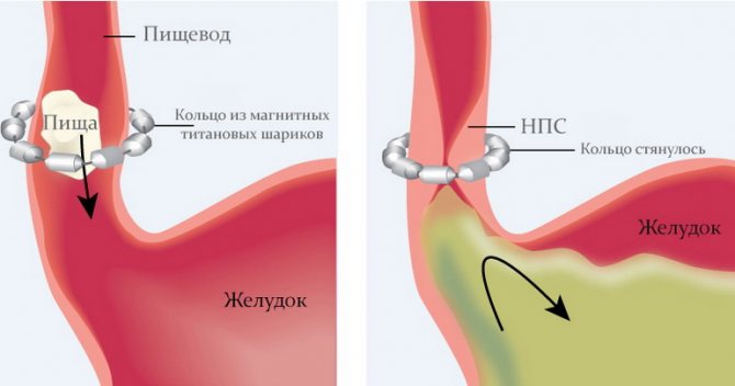 Фундоплікація по Ниссену