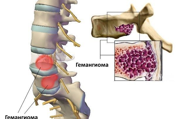 Фото капілярної гемангіоми, її види, симптоми і лікування