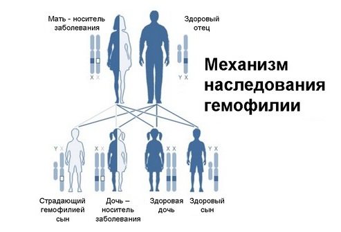 Гемофілія – ​​форми, фактори ризику, лікування і препарати