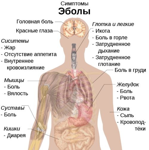 Геморагічна лихоманка.  Симптоми з нирковим синдромом, що це таке, лікування