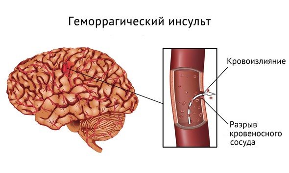 геморагічний інсульт