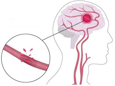 Геморагічний інсульт – причини, лікування і прогноз, наслідки