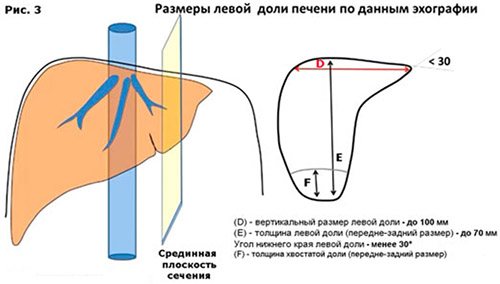 Гепатомегалия (збільшення печінки)