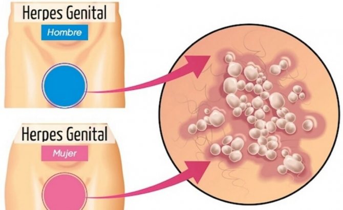 Герпес у чоловіка і жінки