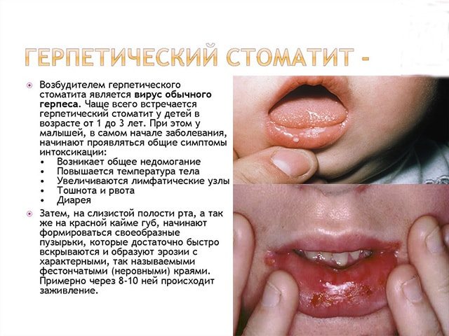 Герпетичний вид хвороби