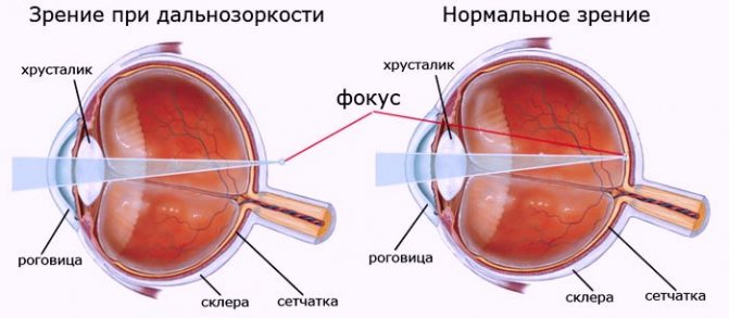 Гіперметропія слабкого ступеня що це таке