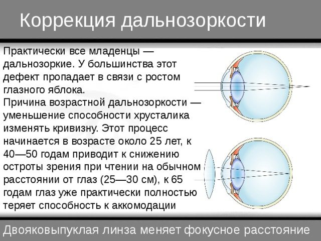 Гіперметропія високого ступеня