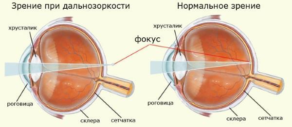 Гіперметропія високого ступеня