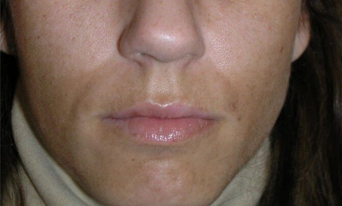 Меланоз шкіри: можливі причини, симптоми і терапія