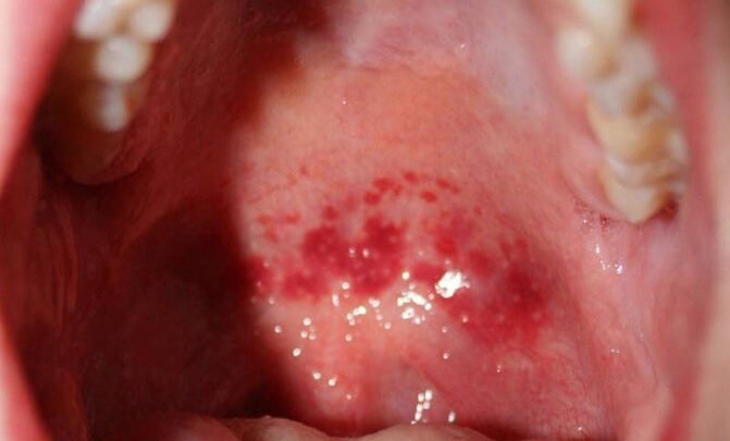 Ознаки та лікування гнійників на задній стінці горла у дитини